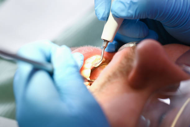 Best Emergency Wisdom Tooth Extraction in Melvindale, MI